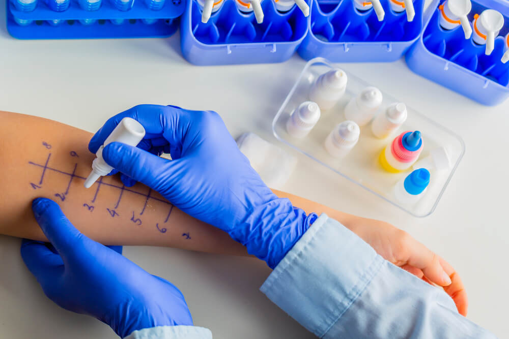 um exame de alergia sendo feito no braço de uma pessoa.