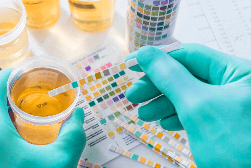 Mãos com luvas verde segurando um potinho do exame de urina