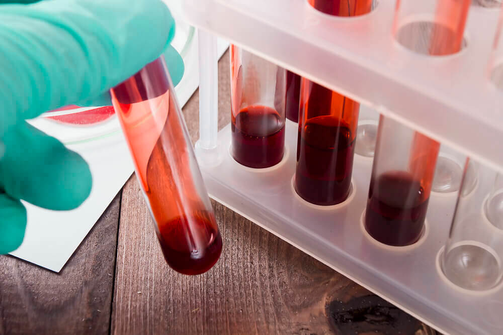 Luva segurando uma ampola quase vazia de sangue. Imagem para ilustrar os sintomas de hepatite B.