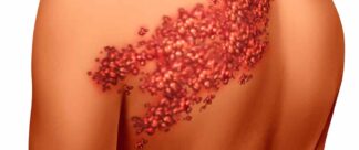 Aprenda tudo sobre o Herpes Zoster
