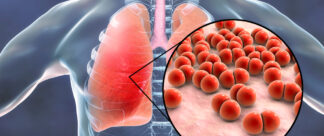 Pneumonia: como se prevenir?