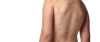 Catapora: saiba tudo sobre a doença e como tratar