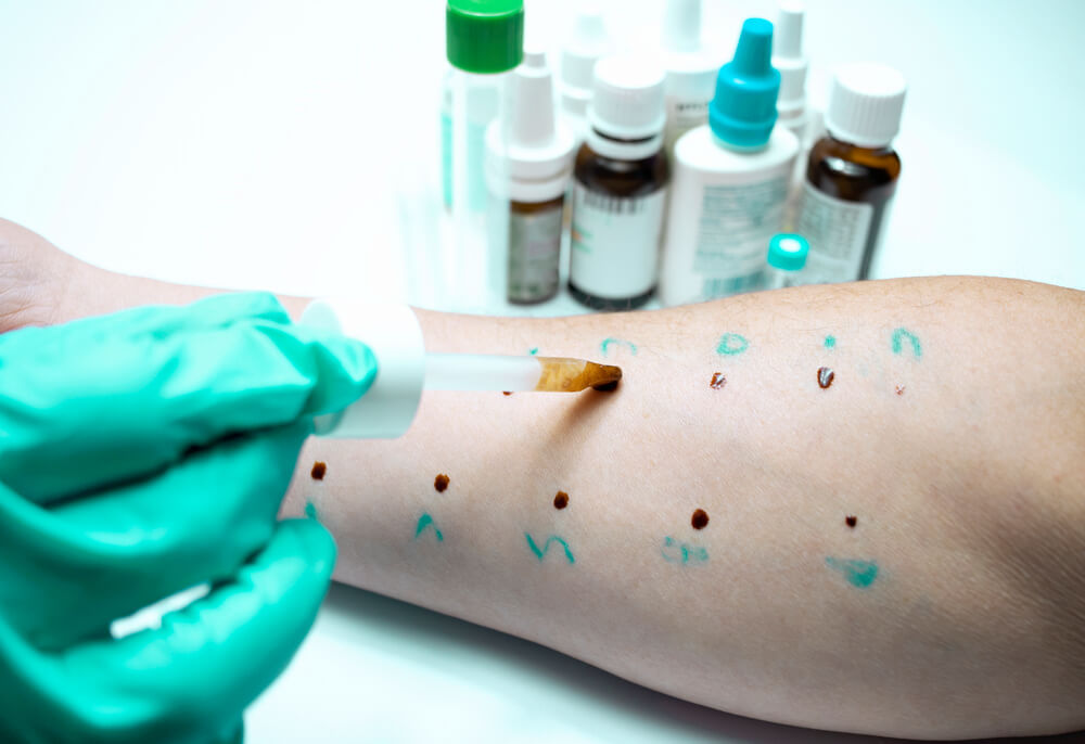 Mão com luva fazendo teste de alergia a medicamentos no braço do paciente.