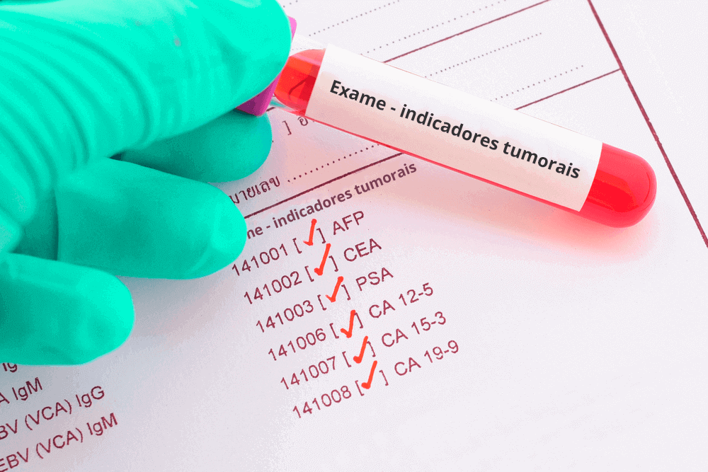 Uma mão com luvas segurando um tubo de amostra de exame de sangue detecta câncer