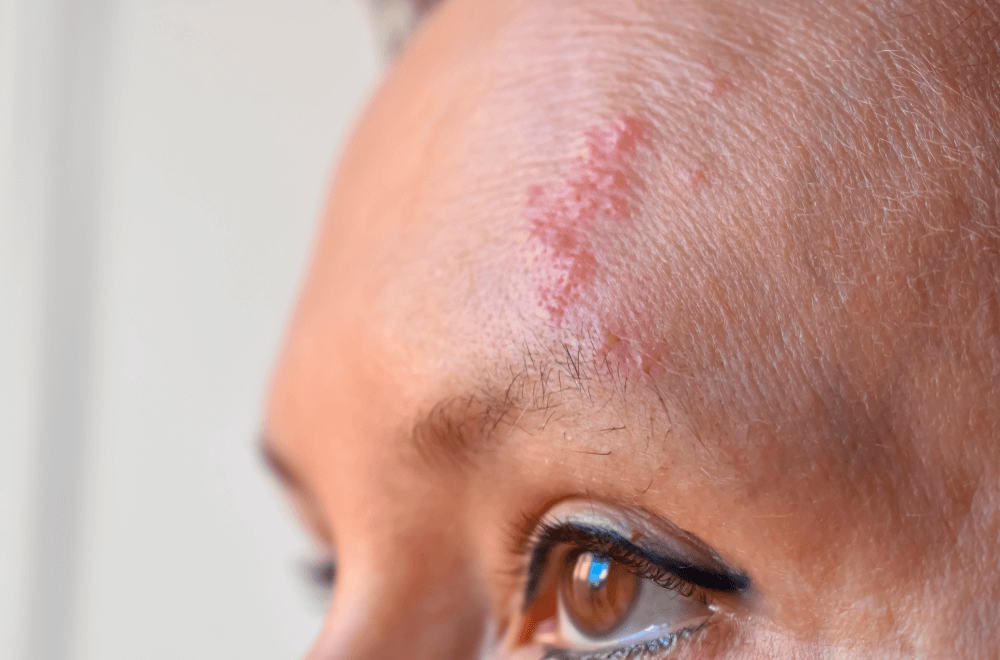 Testa de uma pessoa com as pequenas bolhas avermelhadas que formam as vesículas, representando o que é cobreiro