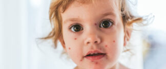 O que é varicela: sintomas, causas e como se prevenir