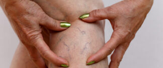 O que é trombose, quais os sintomas e como diagnosticar