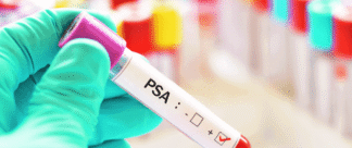 Para que serve o exame de PSA?