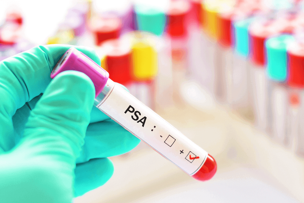 Luva segurando uma ampola de sangue com um check para o resultado positivo. Essa imagem ilustra o post para que serve o exame de PSA.