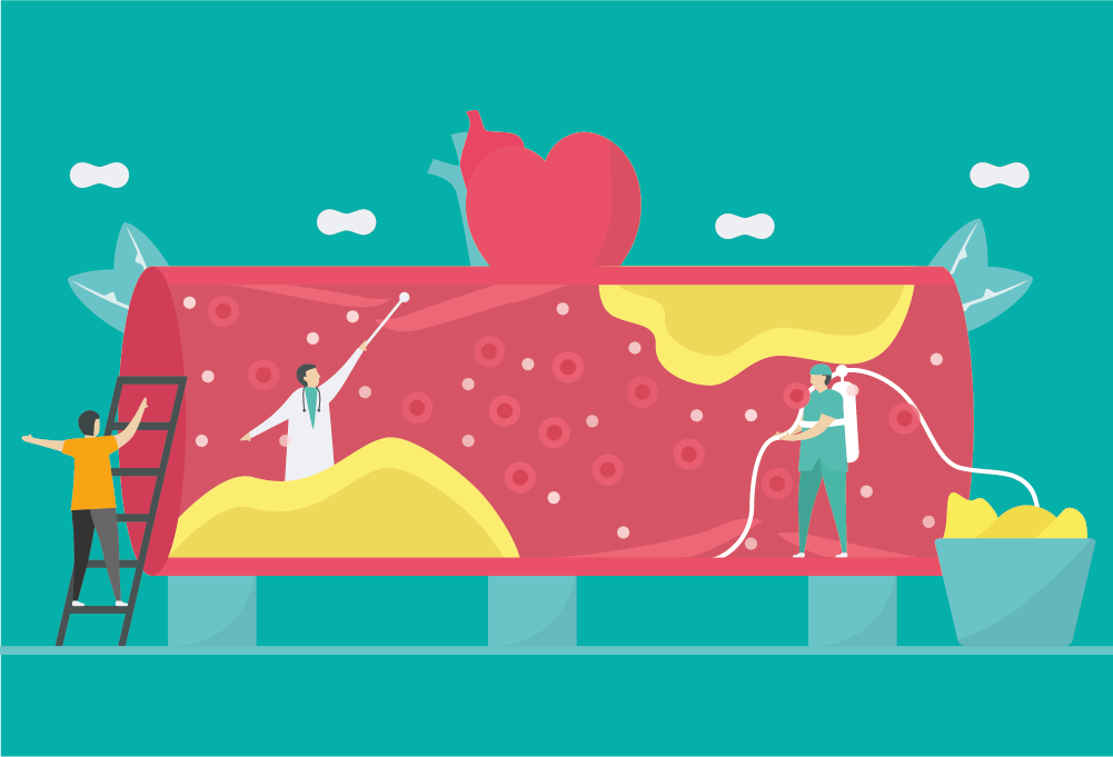 Ilustração de uma veia com excesso de colesterol nas artérias.