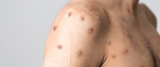 Varíola dos macacos: quais os sintomas mais graves